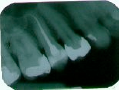 Rötgenbild Endodontie